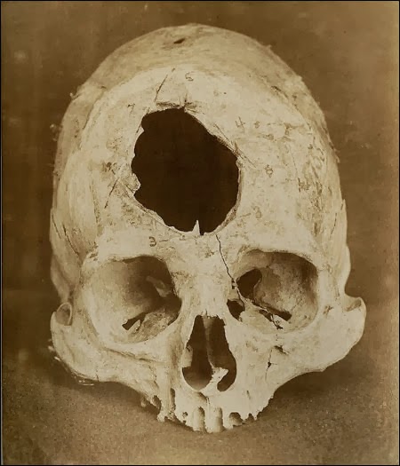 A trepanned skull