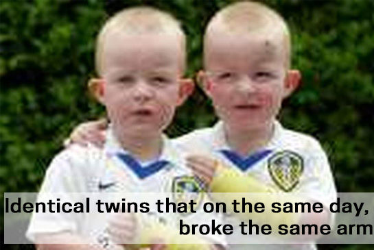 Identical twins that on the same day, broke the same arm