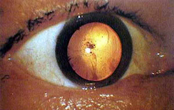 Eyeball of an A-bomb victim