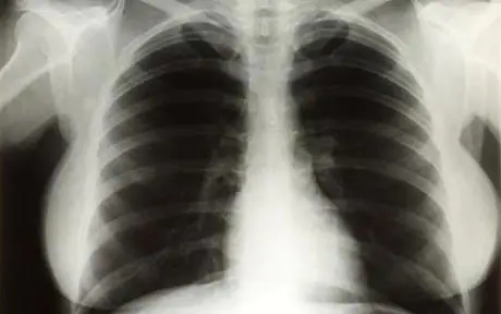 Marilyn Monroe chest X-rays
