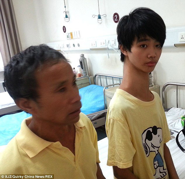 Chinese teen suffering from Congenital scoliosis