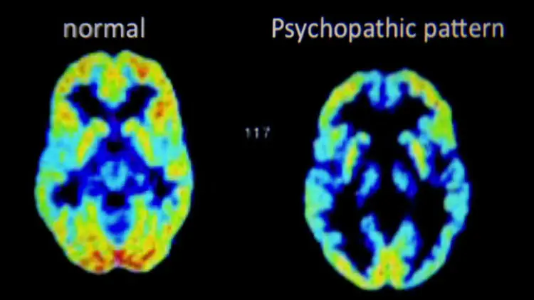 Brain of a Psychopath