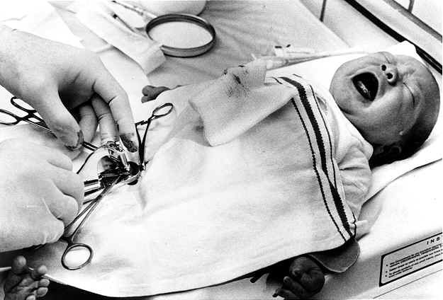 Doctors performed surgeries on babies without anesthesia as late as 1985