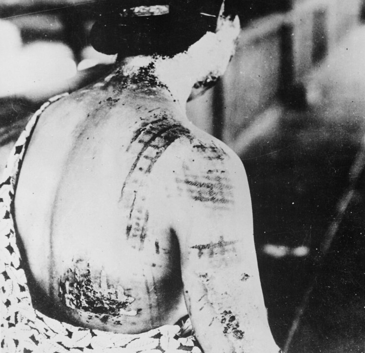 Radiation Victims of Hiroshima