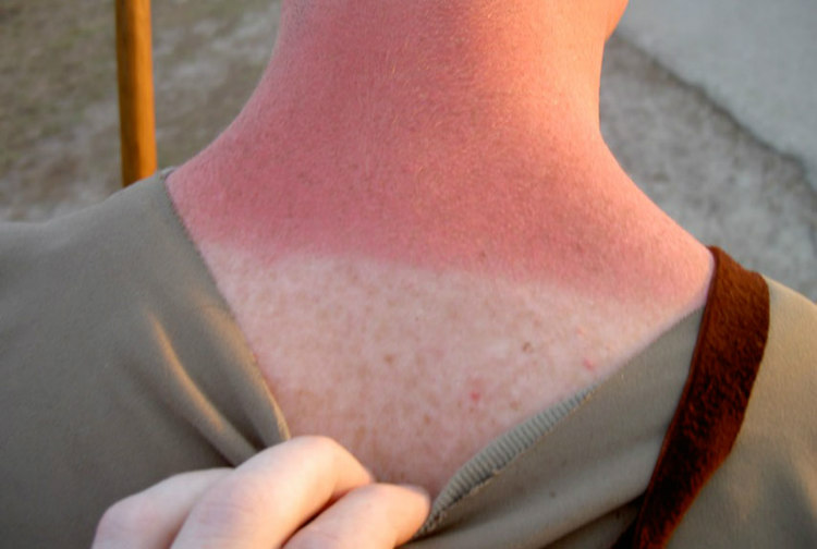 Sunburn Due to DNA Damage