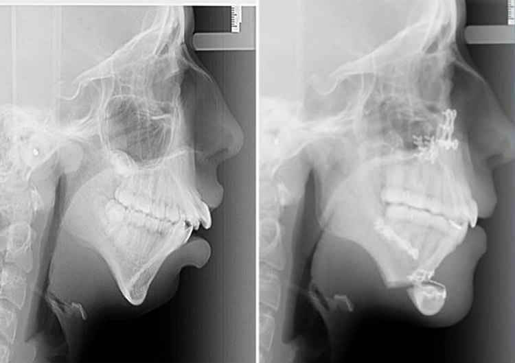 Ellie Jones - Before and After X-Rays