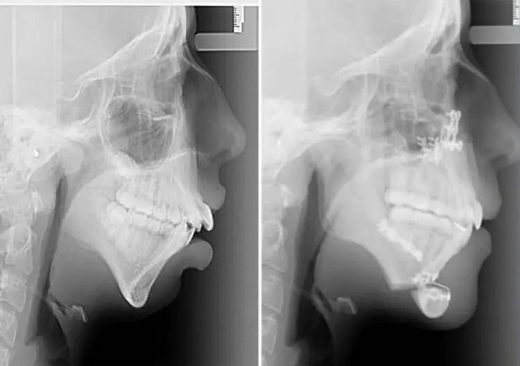 Ellie Jones - Before and After X-Rays