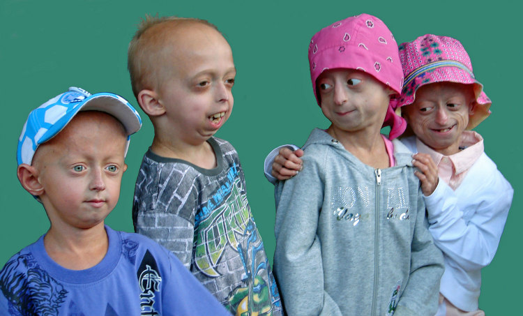 Progeria Prevalence 