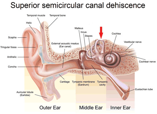 Superior Canal Dehiscence Syndrome