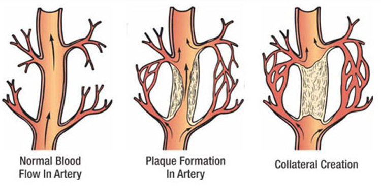 Collateral Circulation in Arteries