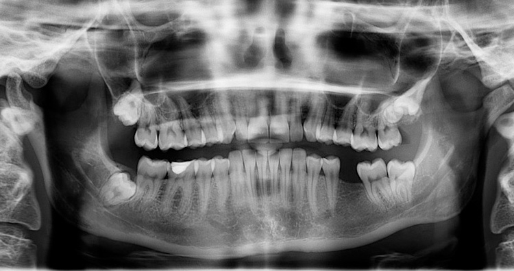 Avulsed teeth