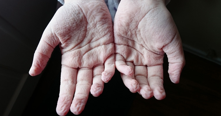 Wrinkled hands due to water