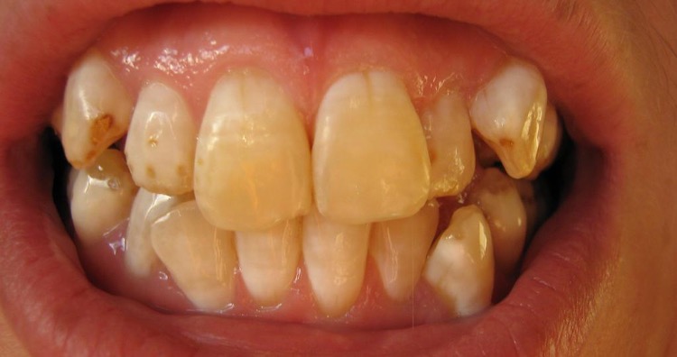 Brown Teeth