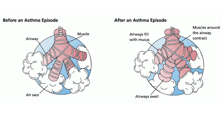 Asthma Episode (Before and After)