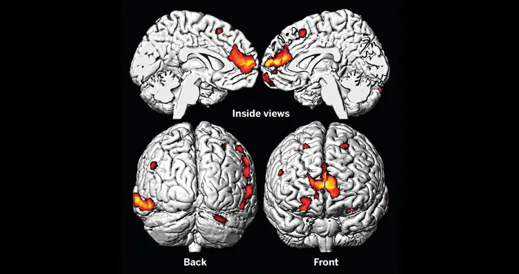 Braiп MRI