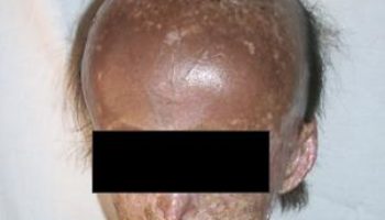 Picture ‘Porphyria’ The Vampires Disease.