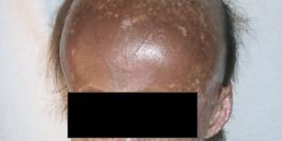 Picture ‘Porphyria’ The Vampires Disease.