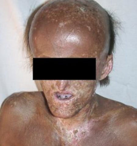 Picture ‘Porphyria’ The Vampires Disease.