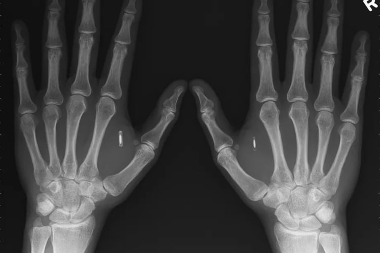 Man implants NFC chip in hands