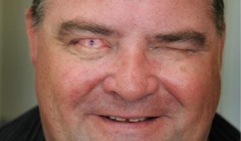 Picture Blind Man Regained His Vision by Having a Tooth Implanted in His Eye