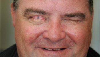 Picture Blind Man Regained His Vision by Having a Tooth Implanted in His Eye