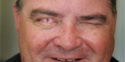 Picture Blind Man Regained His Vision by Having a Tooth Implanted in His Eye