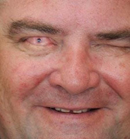 Picture Blind Man Regained His Vision by Having a Tooth Implanted in His Eye