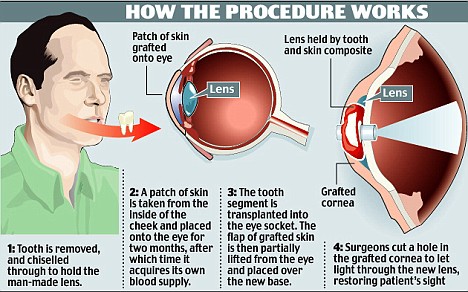 Procedure for tooth eye