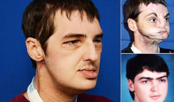 Picture Wonder Of modern Science,Gun Victim Gets a New Face after 15 years.