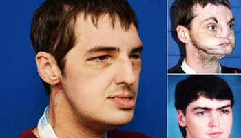Picture Wonder Of modern Science,Gun Victim Gets a New Face after 15 years.