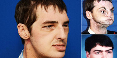 Picture Wonder Of modern Science,Gun Victim Gets a New Face after 15 years.