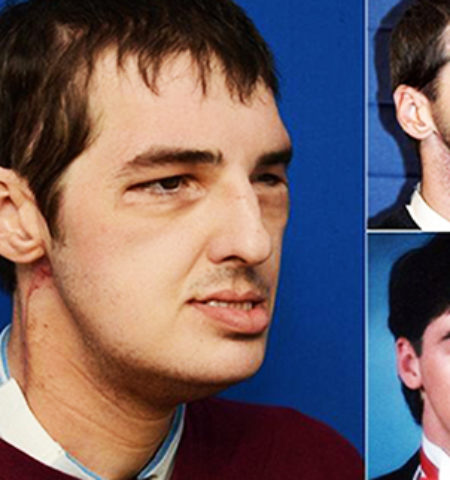 Picture Wonder Of modern Science,Gun Victim Gets a New Face after 15 years.