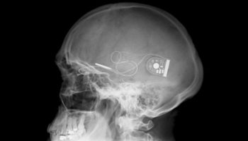 Picture Retinal Implant Gives the Gift of Sight to Nine Blind People.