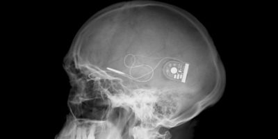 Picture Retinal Implant Gives the Gift of Sight to Nine Blind People.