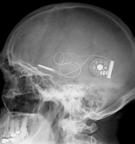 Picture Retinal Implant Gives the Gift of Sight to Nine Blind People.