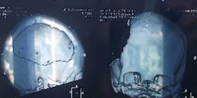 Picture Taisia Sidorova, Develops Artistic Talent After Losing Half Of Brain