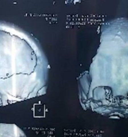 Picture Taisia Sidorova, Develops Artistic Talent After Losing Half Of Brain