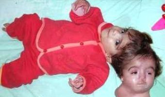 Picture Egyptian Girl With 2 Two Heads and One Body- Unbelievably tragic!