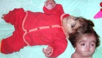 Picture Egyptian Girl With 2 Two Heads and One Body- Unbelievably tragic!