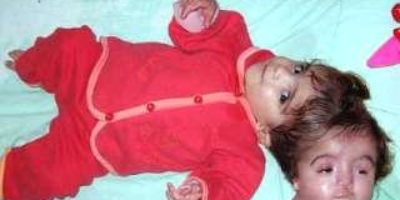 Picture Egyptian Girl With 2 Two Heads and One Body- Unbelievably tragic!