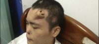 Picture A Man From China Grows A New Nose On His Forehead