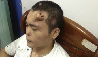Picture A Man From China Grows A New Nose On His Forehead