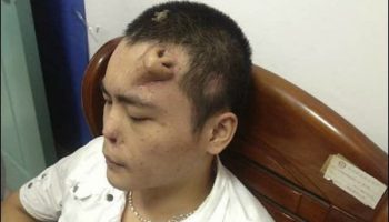 Picture A Man From China Grows A New Nose On His Forehead