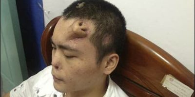Picture A Man From China Grows A New Nose On His Forehead