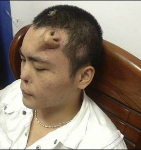 Picture A Man From China Grows A New Nose On His Forehead
