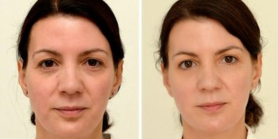 Picture This Woman Drinks 3 Litres Of Water Every Day And The Results Are Shocking!