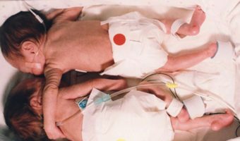 Picture Two Decades Ago Their ‘Rescuing Hug’ Stunned The World And Revolutionised Medicine