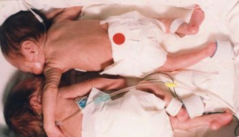 Picture Two Decades Ago Their ‘Rescuing Hug’ Stunned The World And Revolutionised Medicine