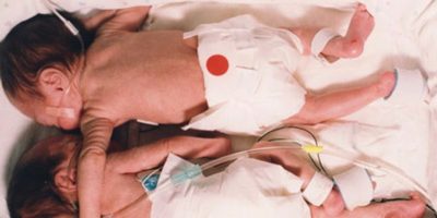 Picture Two Decades Ago Their ‘Rescuing Hug’ Stunned The World And Revolutionised Medicine