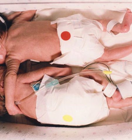 Picture Two Decades Ago Their ‘Rescuing Hug’ Stunned The World And Revolutionised Medicine